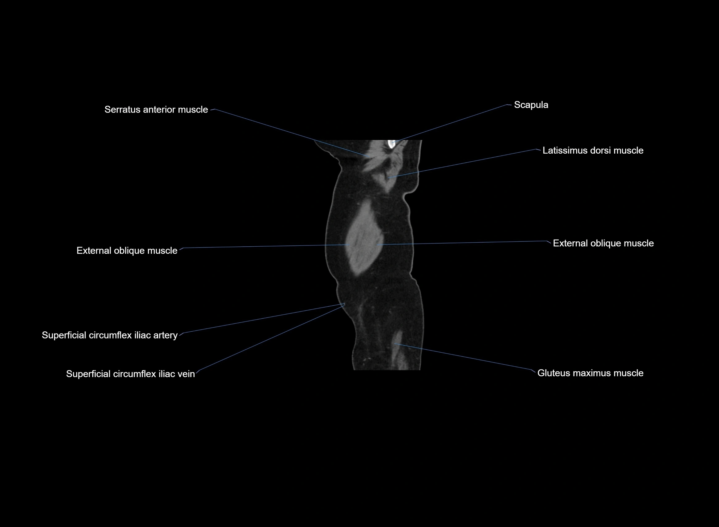 CT Abdomen sagittal cross sectional anatomy labelled radiology image -00108.webp